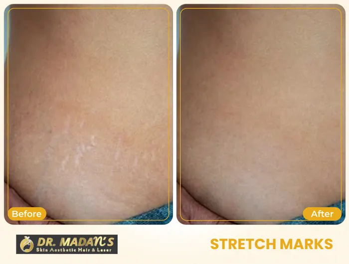 Stretch marks before and after result 7 at Dr Madan Aesthetics